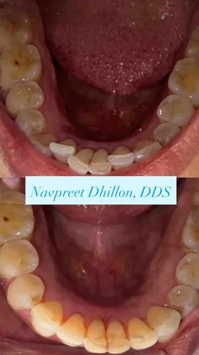 Before and after lower teeth alignment from Nelson Dental Practice's smile gallery